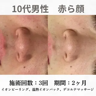 重度ニキビ専門🌷 ダウンタイムなしのエステ・リラクイメージ