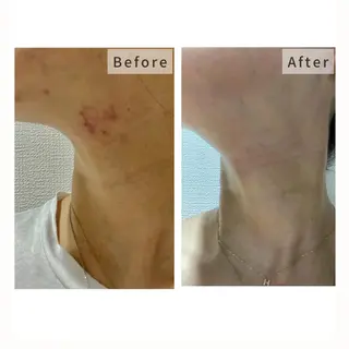 ハーブピーリング🌹 Homieのエステ・リラクイメージ