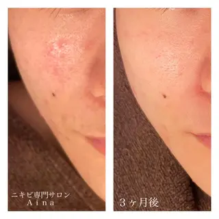 ミディアム カラー パーマ ヘアアレンジ メンズ キッズ ネイル マツエク・マツパ ニキビ跡専門サロン Ainaのエステ・リラクイメージ