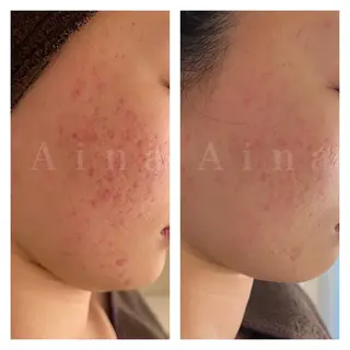 セミロング パーマ ヘアアレンジ メンズ キッズ ネイル マツエク・マツパ アイブロウ ニキビ跡専門サロン Ainaのエステ・リラクイメージ