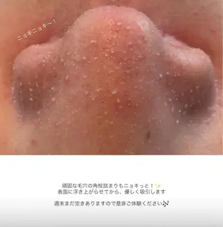 himee所属・艶肌ハーブピーリング /毛穴洗浄のエステ・リラクイメージ