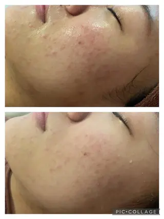 ショート カラー パーマ ヘアアレンジ メンズ キッズ ネイル マツエク・マツパ アイブロウ 3か月で肌革命👼 ニキビ専門店💫のエステ・リラクイメージ