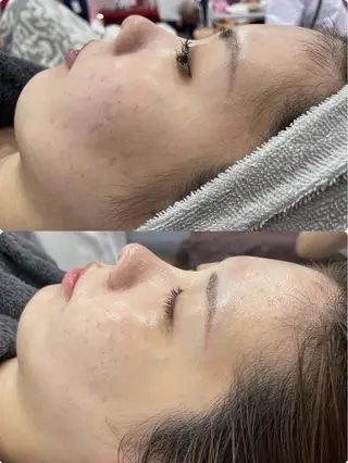 ニキビ／毛穴ケア ハーブピーリングのエステ・リラクイメージ