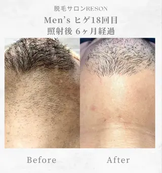 メンズ 都度払いの脱毛サロン RESONのエステ・リラクイメージ