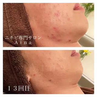 セミロング カラー パーマ ヘアアレンジ メンズ キッズ ネイル マツエク・マツパ ニキビ跡専門サロン Ainaのエステ・リラクイメージ