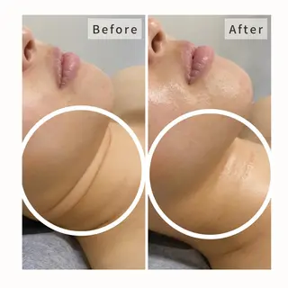 ハーブピーリング🌹 Homieのエステ・リラクイメージ