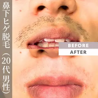 メンズ 【一本ずつ脱毛】 ReMove 柏のエステ・リラクイメージ