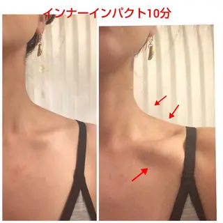 ニキビ•ニキビ跡改善 salon varyのエステ・リラクイメージ