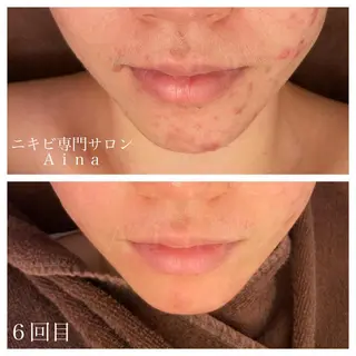 セミロング パーマ ヘアアレンジ メンズ キッズ ネイル マツエク・マツパ ニキビ跡専門サロン Ainaのエステ・リラクイメージ