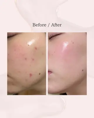 myherb所属・ニキビ肌改善 ハーブピーリング🌿のエステ・リラクイメージ