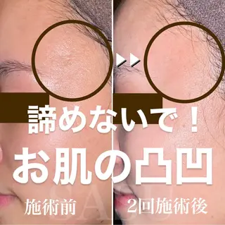 即小顔♥️美容鍼× ハーブピーリングのその他イメージ