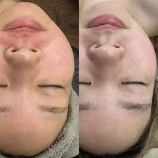 ハーブピーリング専門EMILUCA藤沢所属・ハーブピーリング /KAEDEのエステ・リラクイメージ