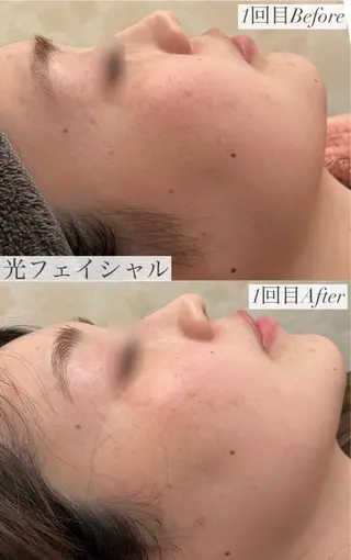 emiluca西目/ 毛穴洗浄/細胞美容のエステ・リラクイメージ