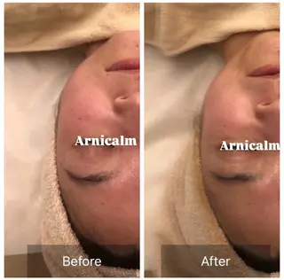 ハーブピーリング 肌再生ピーリング/のエステ・リラクイメージ