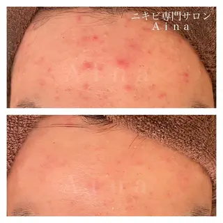 ショート パーマ ヘアアレンジ メンズ マツエク・マツパ アイブロウ ニキビ跡専門サロン Ainaのエステ・リラクイメージ