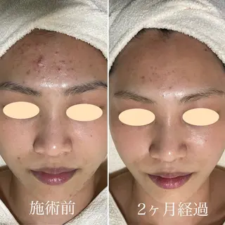 ニキビ・毛穴・ フェイシャル専門店のエステ・リラクイメージ