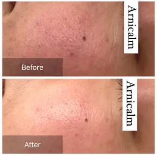 ハーブピーリング 肌再生ピーリング/のエステ・リラクイメージ