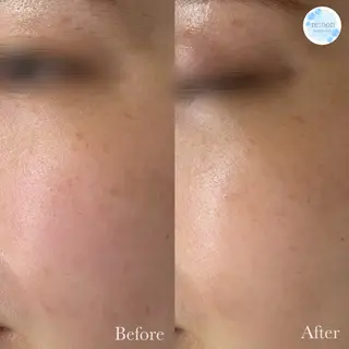 美容鍼脱毛salon リノン吹田駅前店のエステ・リラクイメージ