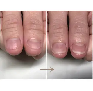 ネイル 深爪矯正・自爪育成 ヴェールリムのネイルデザイン