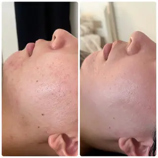 ニキビ・毛穴改善 🌿ハーブピーリングのエステ・リラクイメージ