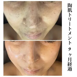 ハーブピーリング専門 毛穴洗浄❤️眉waxのエステ・リラクイメージ