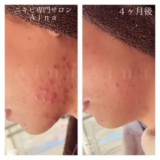 セミロング パーマ ヘアアレンジ メンズ キッズ ネイル マツエク・マツパ ニキビ跡専門サロン Ainaのエステ・リラクイメージ