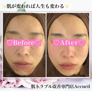 3か月で肌革命👼 ニキビ専門店💫のエステ・リラクイメージ