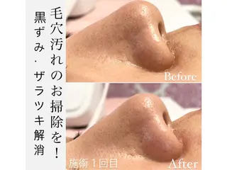 WAX・肌質改善・毛 穴洗浄/林愛真のエステ・リラクイメージ