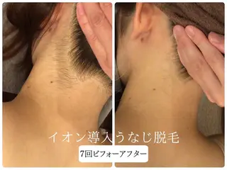 🎀うなじ脱毛🎀 ㅣLino堀江のエステ・リラクイメージ
