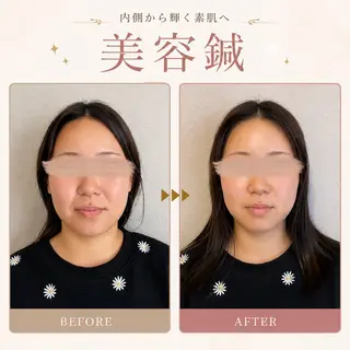 美容鍼×ブライダル かずでぃー 大阪梅田のエステ・リラクイメージ