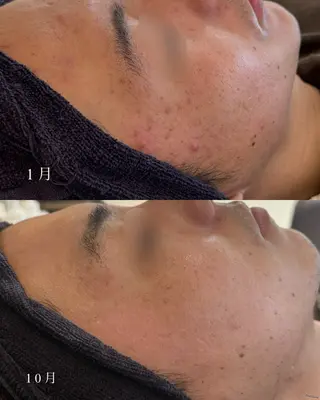 yukiko/美容師 ニキビ特化/肌質改善のエステ・リラクイメージ