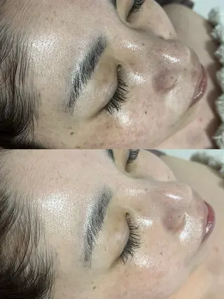 ニキビ／毛穴ケア ハーブピーリングのエステ・リラクイメージ