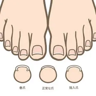 巻き爪補正店 堺東店のネイルデザイン