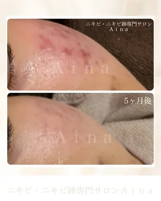 ニキビ跡専門サロン Ainaのエステ・リラクイメージ