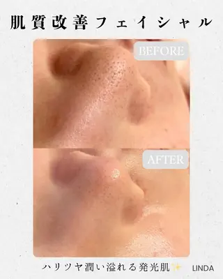 小顔&毛穴・肌質改善 LINDA西宮 AIのその他イメージ