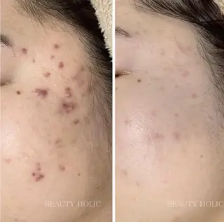 ニキビ・ 肌荒れ専門店のエステ・リラクイメージ