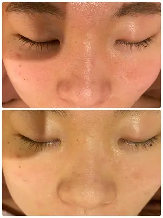 セミロング カラー パーマ ヘアアレンジ メンズ キッズ ネイル マツエク・マツパ アイブロウ 3か月で肌革命👼 ニキビ専門店💫のエステ・リラクイメージ