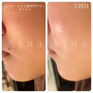 ニキビ跡専門サロン Ａｉｎａのエステ・リラクイメージ