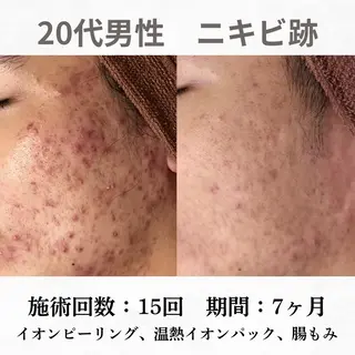 重度ニキビ専門🌷 ダウンタイムなしのエステ・リラクイメージ