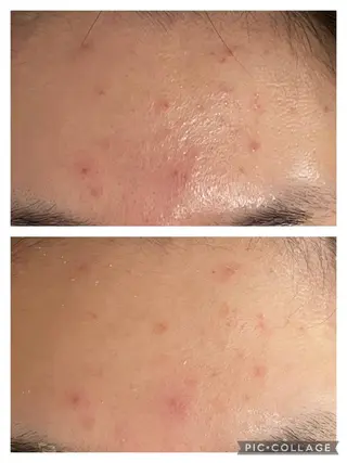 セミロング カラー パーマ ヘアアレンジ メンズ キッズ ネイル マツエク・マツパ アイブロウ 3か月で肌革命👼 ニキビ専門店💫のエステ・リラクイメージ
