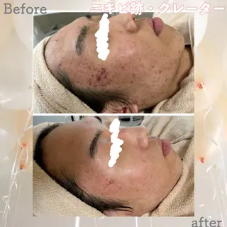 メンズ ニキビ&跡改善サロン オーナー光木のエステ・リラクイメージ