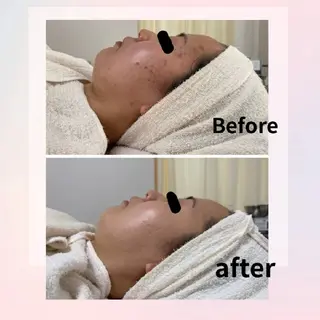 ニキビ・ニキビ跡専門 レゾン京橋店　のエステ・リラクイメージ