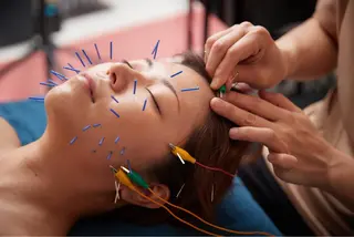 美楽鍼 びらくしんのその他イメージ