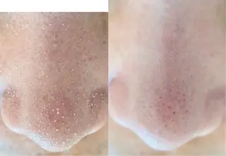 韓国式3D毛穴洗浄 lonhanaのその他イメージ