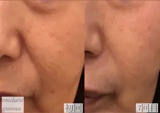 🤍アベシュリ /フェイシャル🤍のエステ・リラクイメージ