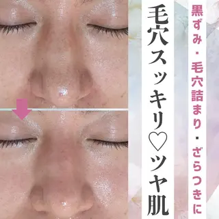 |ピーリング・毛穴| soina神楽坂のエステ・リラクイメージ