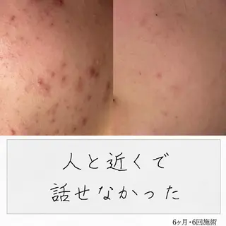 ニキビ経験者が施術 する専門サロン🌻のエステ・リラクイメージ