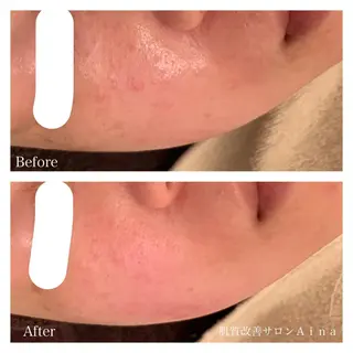 セミロング ヘアアレンジ キッズ ネイル マツエク・マツパ ニキビ跡専門サロン Ainaのエステ・リラクイメージ