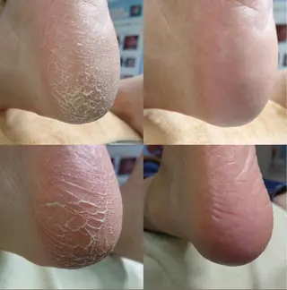 巻き爪アカデミー 溝の口のネイルデザイン