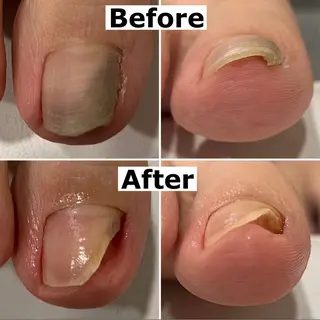 ネイル Mellow nail所属・巻爪無料モデル募集 ✨🦶MEGUMIのネイルデザイン